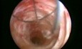 Common Bile Duct Stone Removal - Laparoscopy