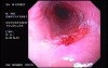 Barrett´s Esophagus (2 of 4)