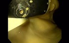 Endoscopic Balloon Removal (4 of 9)