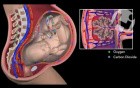 Decreased Fetal Circulation Due to Placental Infarction