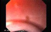 Presence of Multiple Irregular and Large Ulcers - Retroflexed View, Part 1