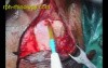 Cochlear Implantation - Part 1 