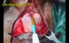 Cochlear Implantation - Part 1 