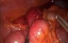Occlusion Clamp On Laparoscopic 