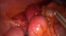 Occlusion Clamp On Laparoscopic 
