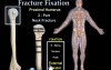 Fracture Fixation & Surgical Techniques - Video Animation