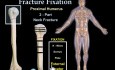 Fracture Fixation & Surgical Techniques - Video Animation
