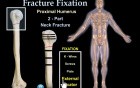 Fracture Fixation & Surgical Techniques - Video Animation