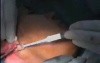 Neck smas lift and Lower face