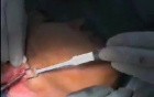 Neck smas lift and Lower face