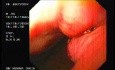 Flexible Endoscopic Suturing - Presence of Knot and Titanum Clip
