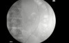 Ureteric Obstruction - Stent Insertion