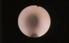 ADAM simulator- nefroscopy and stone removal