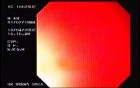 Rectal Cancer That Emerges In The Pectin Line (1 of 3)
