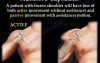 Adhesive Capsulitis & Frozen Shoulder - Video Lecture