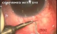 Transciliary filtration in the surgery of acute glaucoma