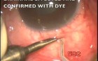 Transciliary filtration in the surgery of acute glaucoma