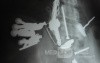 Multiple Foreign bodies in the GI tract (9 of 12)