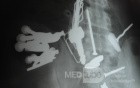 Multiple Foreign bodies in the GI tract (9 of 12)