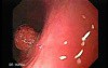 Hyperplastic Polyps - Endoscopy (1 of 14)