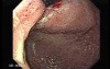 Adenocarcinoma of the Cardias - Main Lesion In the Gastric Fundus, Retroflexed View
