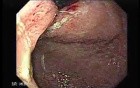 Adenocarcinoma of the Cardias - Main Lesion In the Gastric Fundus, Retroflexed View