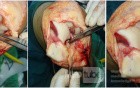 Osteochonderitis dissecans