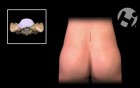 Lumbar Laminotomy And L5-S1 Discectomy
