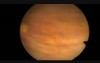 Transurethral Resection of Bladder Tumour - TURBT