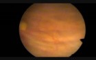 Transurethral Resection of Bladder Tumour - TURBT