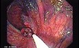 Sessile Tubulovillous Adenoma (9 of 11)