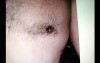 Gynecomastia treatment - surgical video