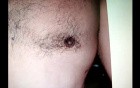 Gynecomastia treatment - surgical video