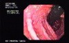 Familial Adenomatous Polyposis of the Colon (7 of 29)
