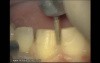 Initial Preparation For Aesthetic Veneers (2/4)
