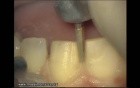 Initial Preparation For Aesthetic Veneers (2/4)