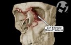 Volumated Facial Fractures