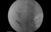 Malignant Ureteral Obstruction - Ureteral Stenting