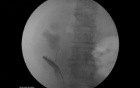 Malignant Ureteral Obstruction - Ureteral Stenting