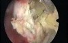 New Resection Master Systeme And Intrauterine Myoma