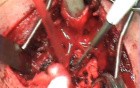 Trachea - Circular Resection 