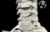 Anterior Cervical Discectomy with Fusion