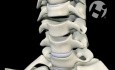 Anterior Cervical Discectomy with Fusion
