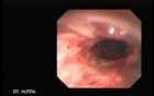 Tracheal Endoscopy 1/5