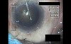 Cataract Surgery VII - Part 1