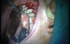 Regeneration Of Multialveolar Process 16-17 (4/4)
