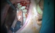 Regeneration Of Multialveolar Process 16-17 (4/4)