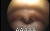 Difference in Palatal and Oropharyngeal Configuration upon Phonation of Vowels