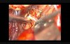 Brain aneurysm - Middle Cerebral Artery Bifurcation - Microsurgical Clipping