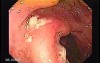 Colonic Tuberculosis Mimicking Crohn's Disease (4 of 12)